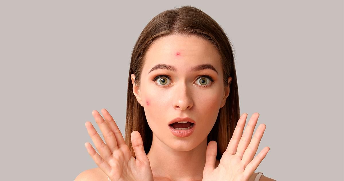 Acnes podem comprometer a estética do rosto causando lesões e incômodos na  pele